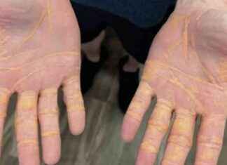 The Dangers of Carnivore Diet: Man Hospitalized Due to Cholesterol Oozing from Hands and Feet the-dangers-of-carnivore-diet-man-hospitalized-due-to-cholesterol-oozing-from-hands-and-feet