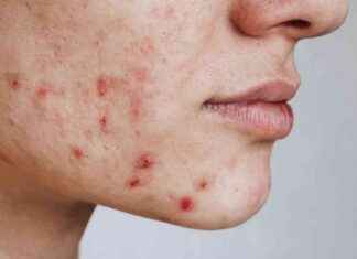 Virus-Based Acne Treatment: The Future of Skincare virus-based-acne-treatment-the-future-of-skincare