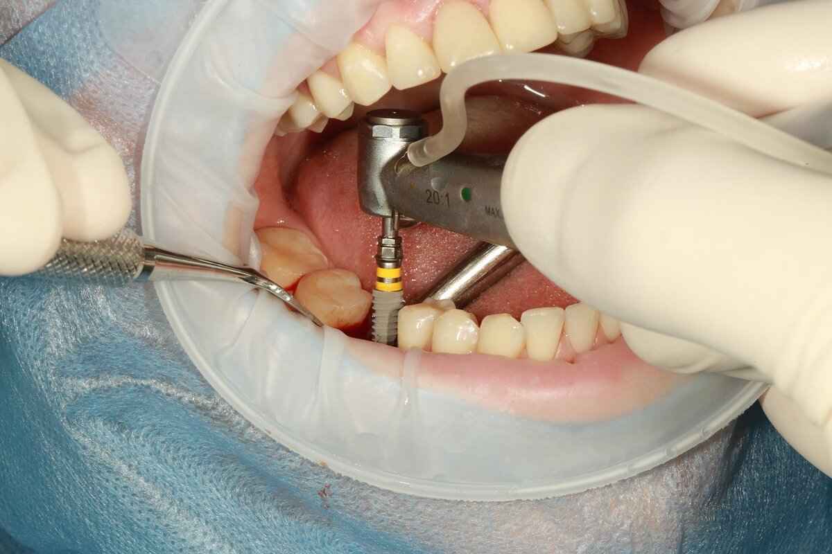 What Causes a Botched Face Lift?