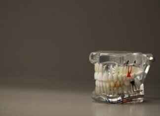 How Much Does It Cost to Reattach a Crown? Dental Costs & Options How Much Does It Cost to Reattach a Crown? Dental Costs & Options