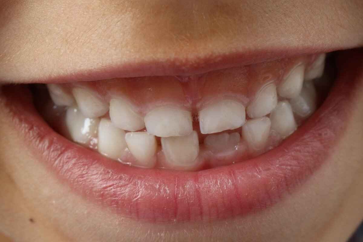 Preventing Chipped Teeth