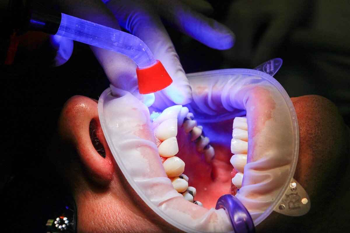 How to Cure Gingivitis Naturally: Effective Remedies and Tips 8 When to Seek Professional Help