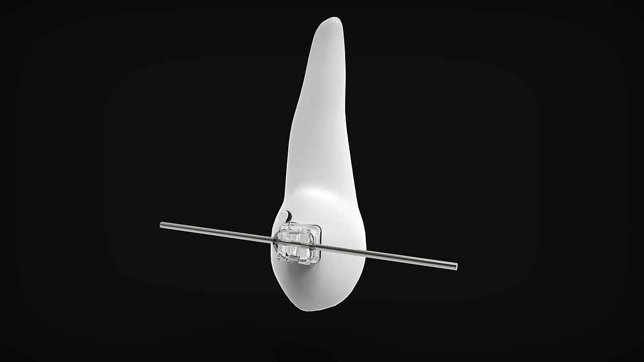 Who Should Choose Lingual Braces?