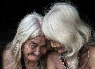 The Most Expensive Hair Transplant Clinics in the World The Most Expensive Hair Transplant Clinics in the World