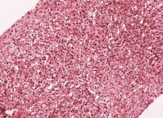 ‘Hepatitis A Outbreak: Urgent Action Needed in L.A. County’ hepatitis-a-outbreak-urgent-action-needed-in-la-county